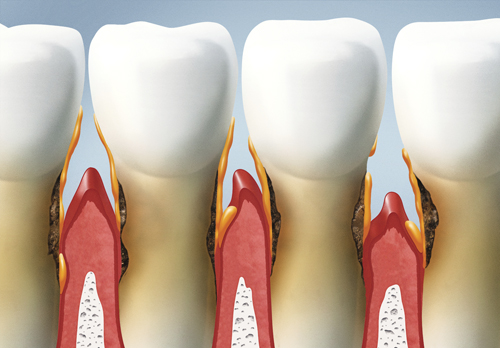 periodontal disease