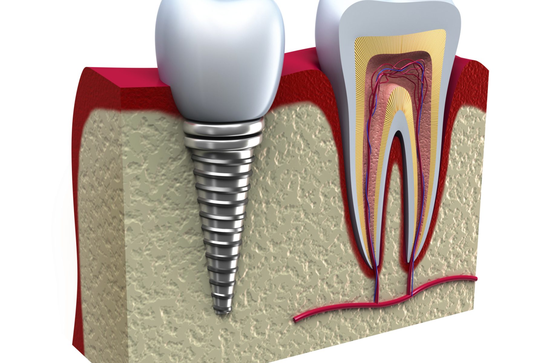 dental implant